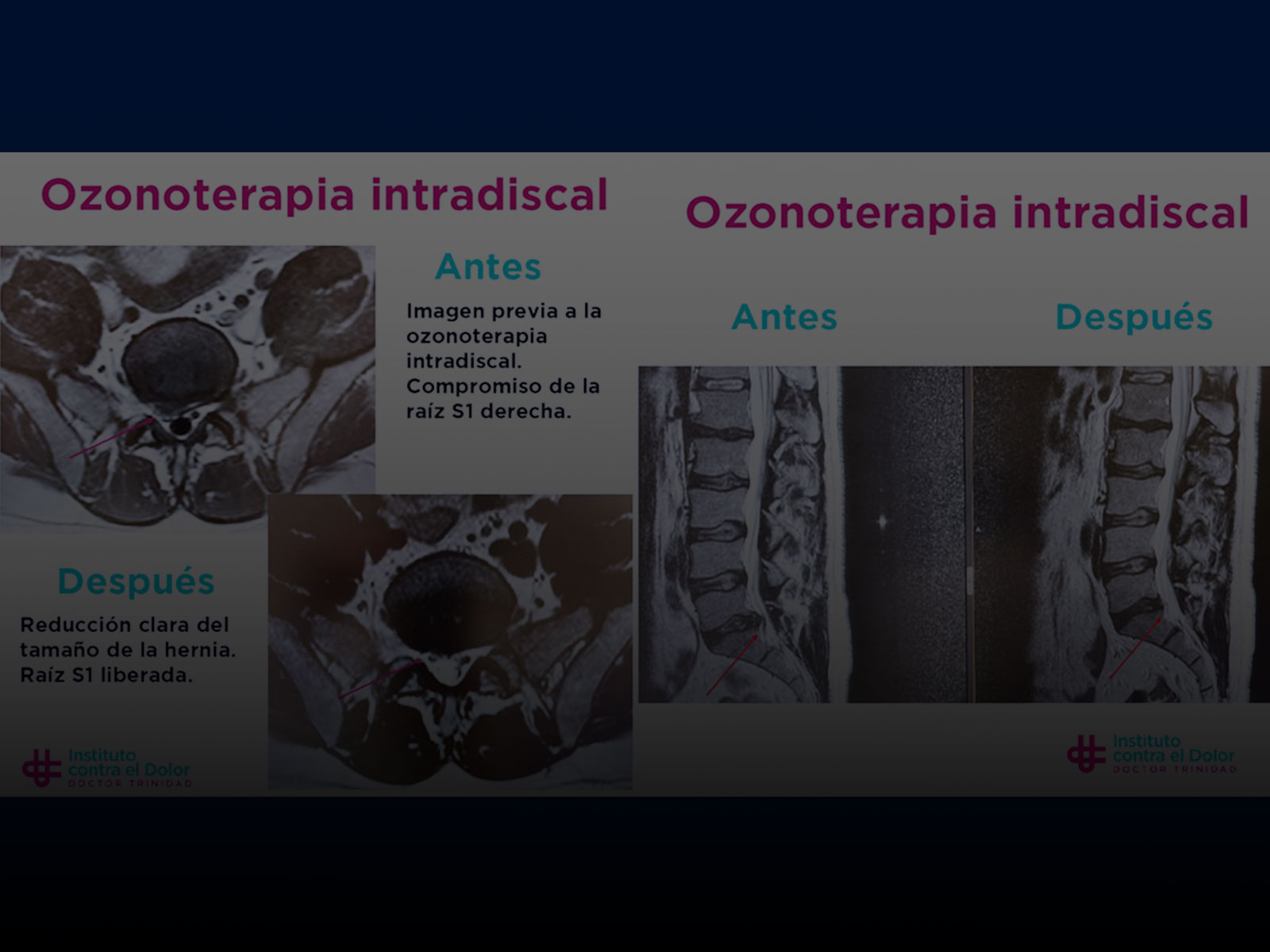 Ozonoterapia Intradiscal – Antes y Después. Instituto contra el dolor Dr. Trinidad.